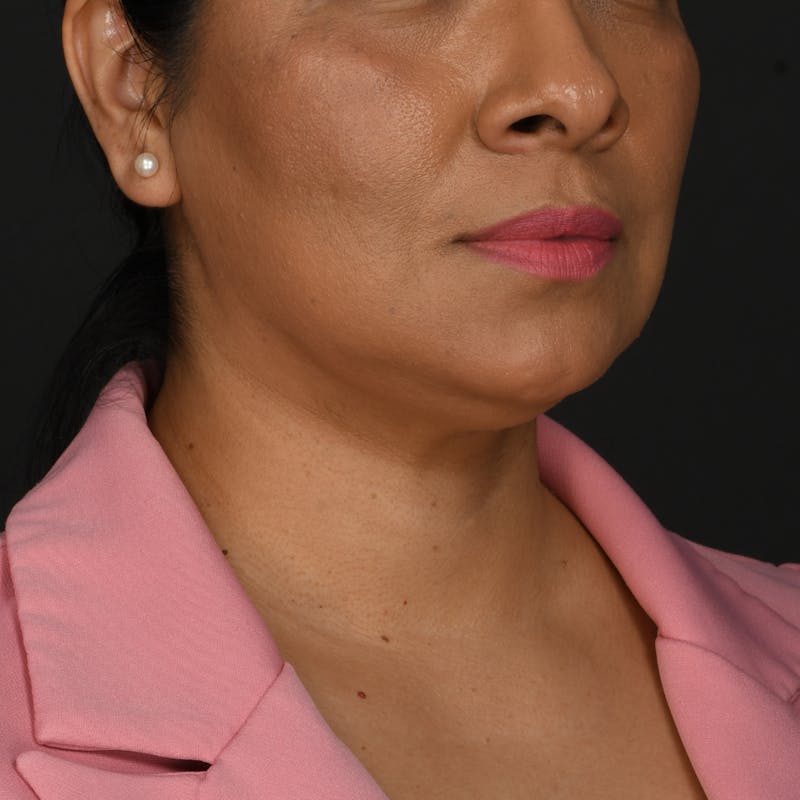 Buccal Fat Removal Before & After Gallery - Patient 363384 - Image 3