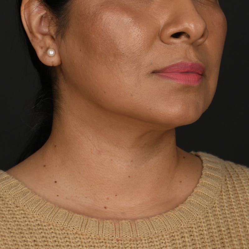 Buccal Fat Removal Before & After Gallery - Patient 363384 - Image 4