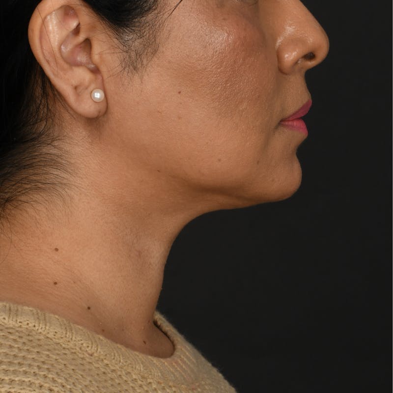 Buccal Fat Removal Before & After Gallery - Patient 363384 - Image 6