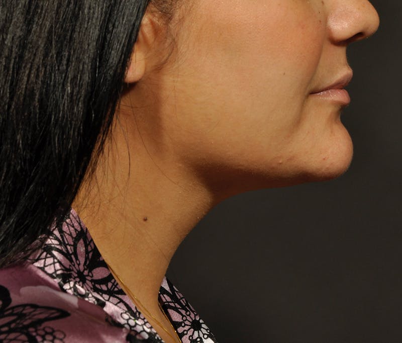 Submental Liposuction Before & After Gallery - Patient 368206 - Image 8