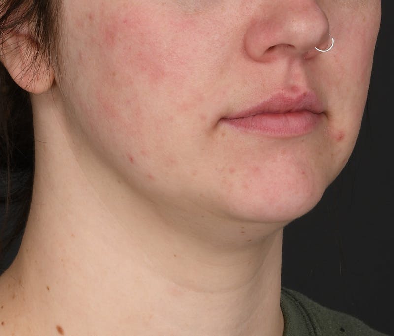 Submental Liposuction Before & After Gallery - Patient 617988 - Image 5