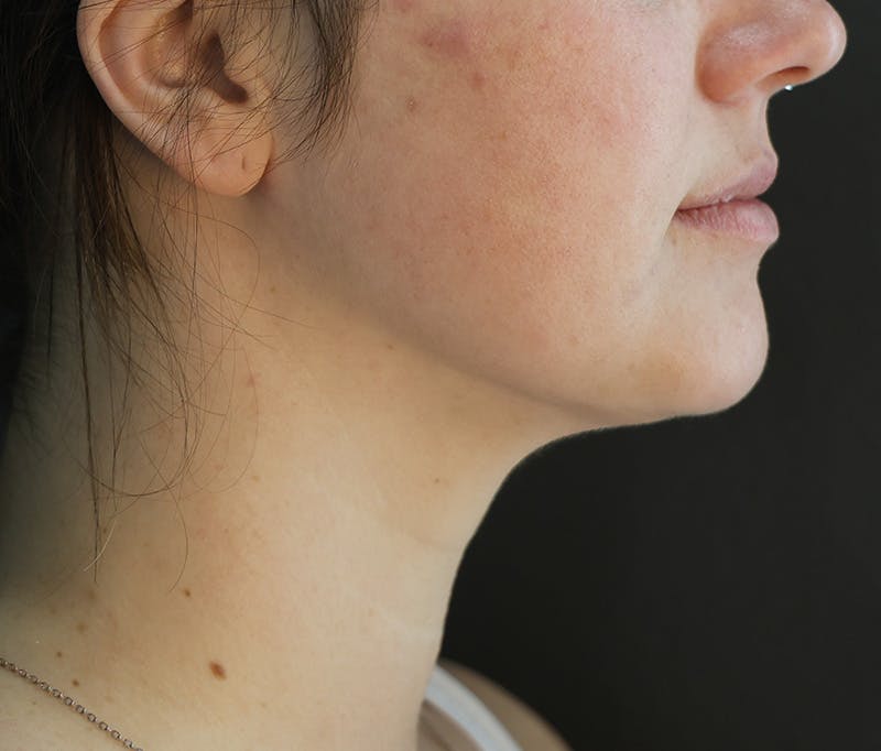 Submental Liposuction Before & After Gallery - Patient 617988 - Image 4