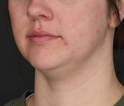 Submental Liposuction Before & After Gallery - Patient 617988 - Image 1