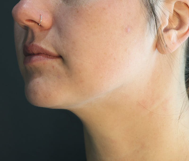 Submental Liposuction Before & After Gallery - Patient 617988 - Image 2