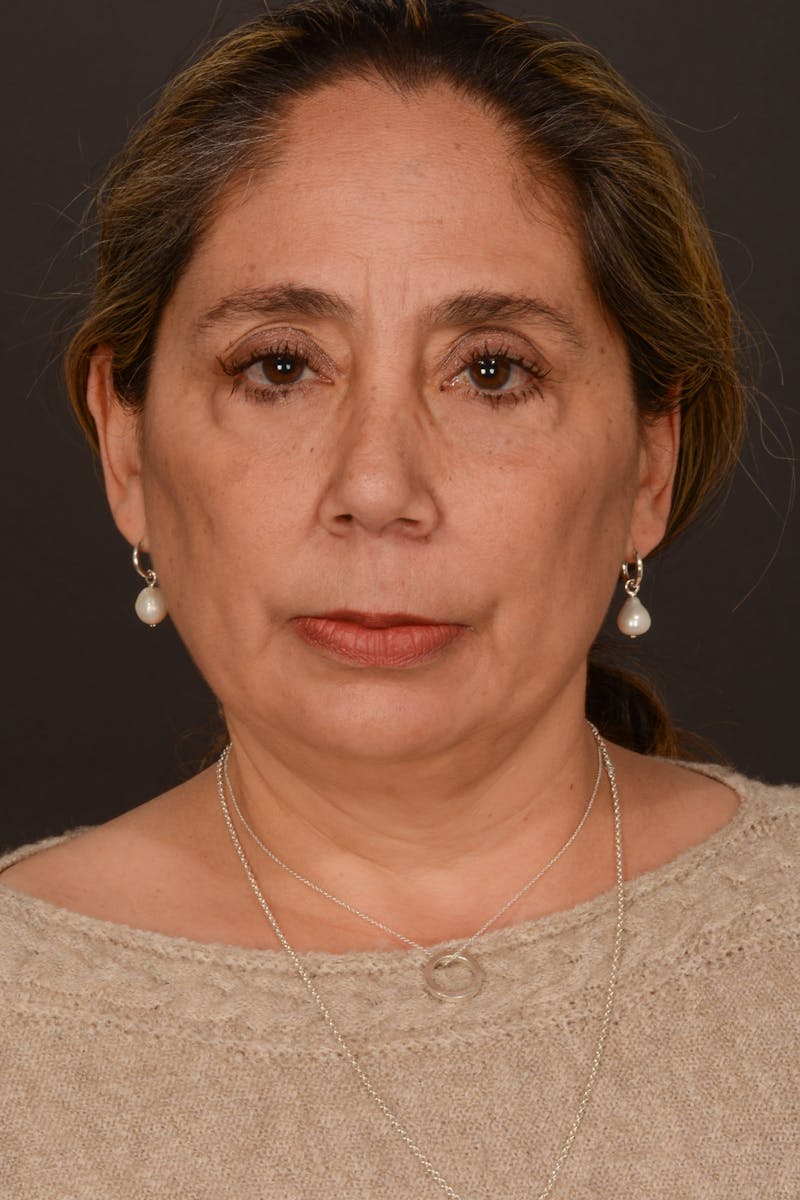 Submental Liposuction Before & After Gallery - Patient 325491 - Image 1