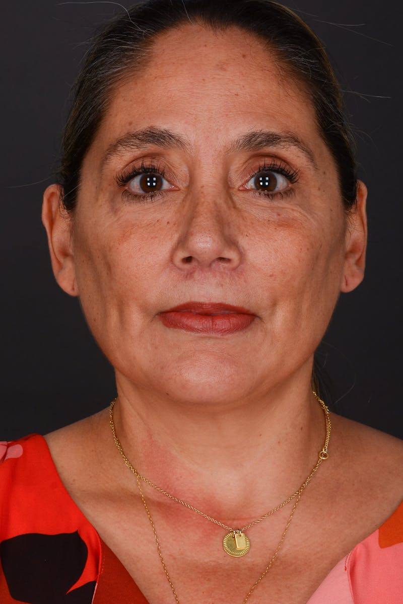 Submental Liposuction Before & After Gallery - Patient 325491 - Image 2