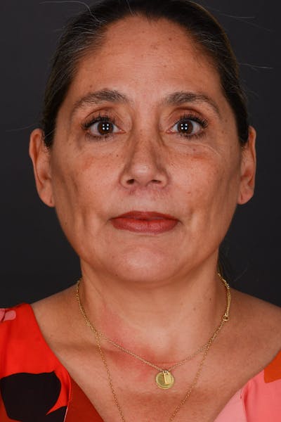 Submental Liposuction Before & After Gallery - Patient 325491 - Image 2