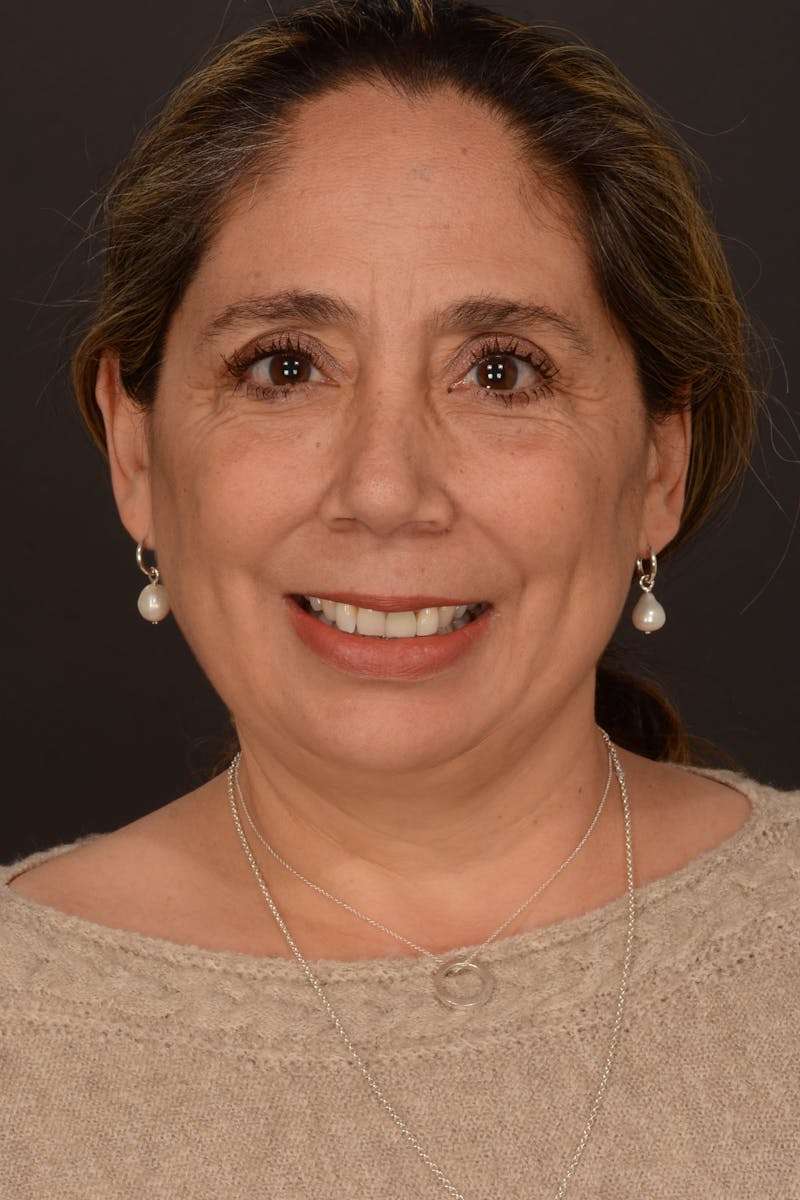 Submental Liposuction Before & After Gallery - Patient 325491 - Image 3