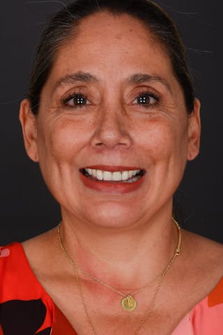 Submental Liposuction Before & After Gallery - Patient 325491 - Image 4