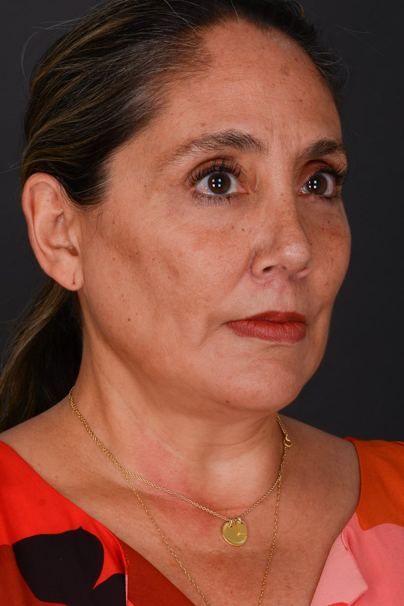 Submental Liposuction Before & After Gallery - Patient 325491 - Image 6