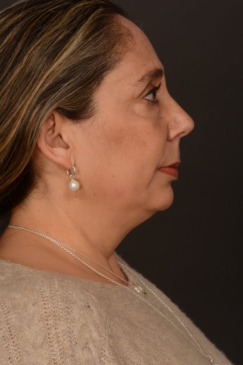 Submental Liposuction Before & After Gallery - Patient 325491 - Image 9