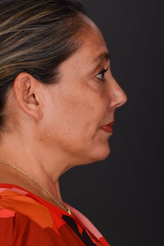 Submental Liposuction Before & After Gallery - Patient 325491 - Image 10