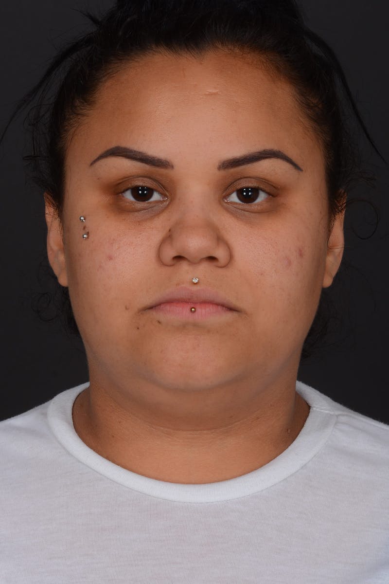 Submental Liposuction Before & After Gallery - Patient 577282 - Image 1