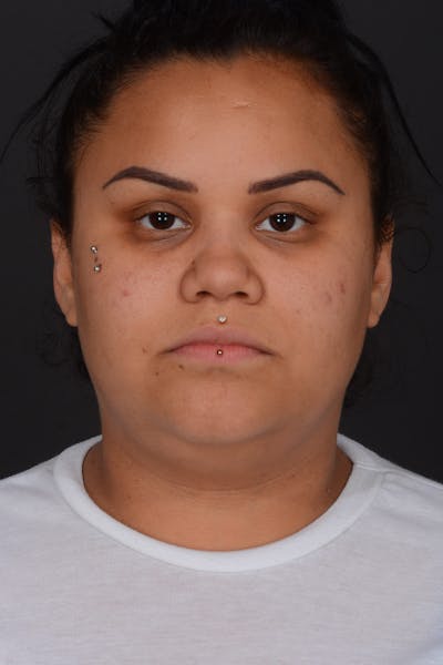 Submental Liposuction Before & After Gallery - Patient 577282 - Image 1