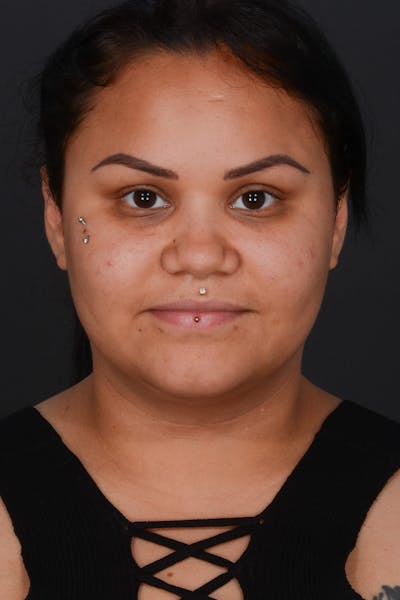 Submental Liposuction Before & After Gallery - Patient 577282 - Image 2