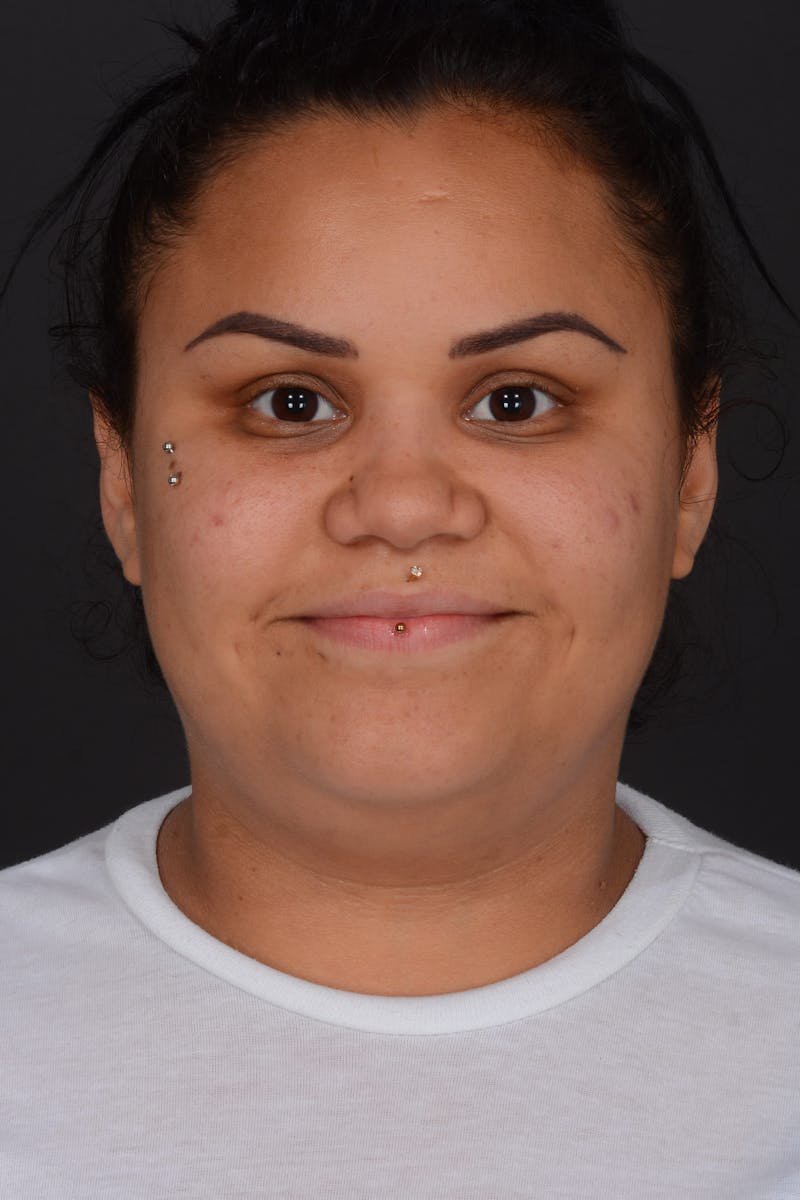 Submental Liposuction Before & After Gallery - Patient 577282 - Image 3