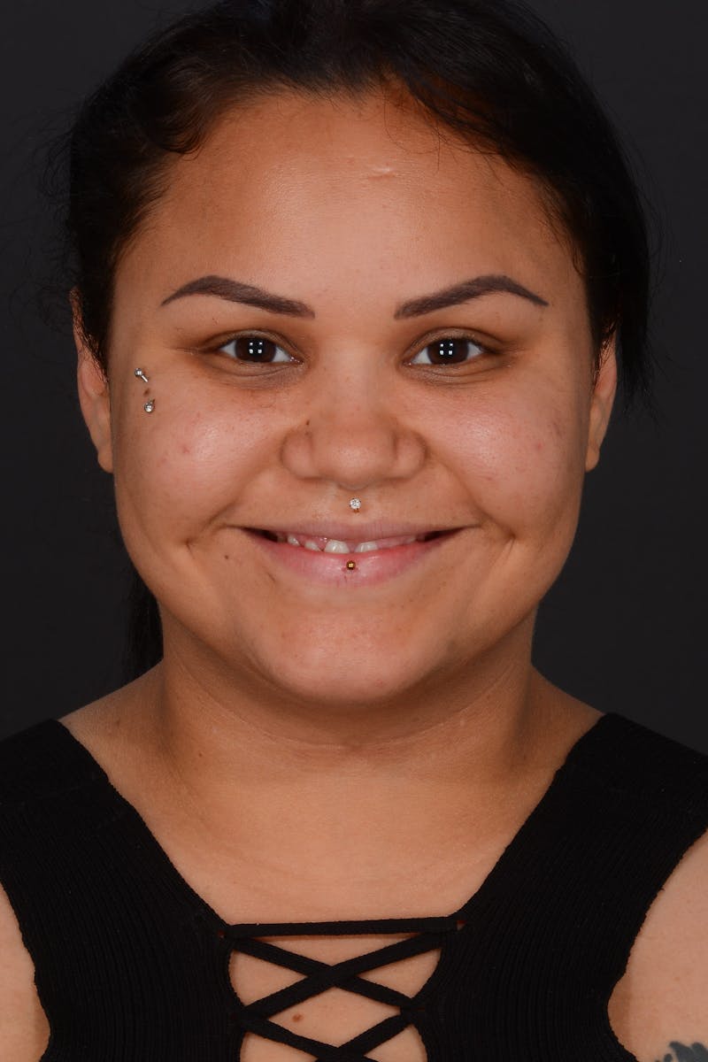 Submental Liposuction Before & After Gallery - Patient 577282 - Image 4