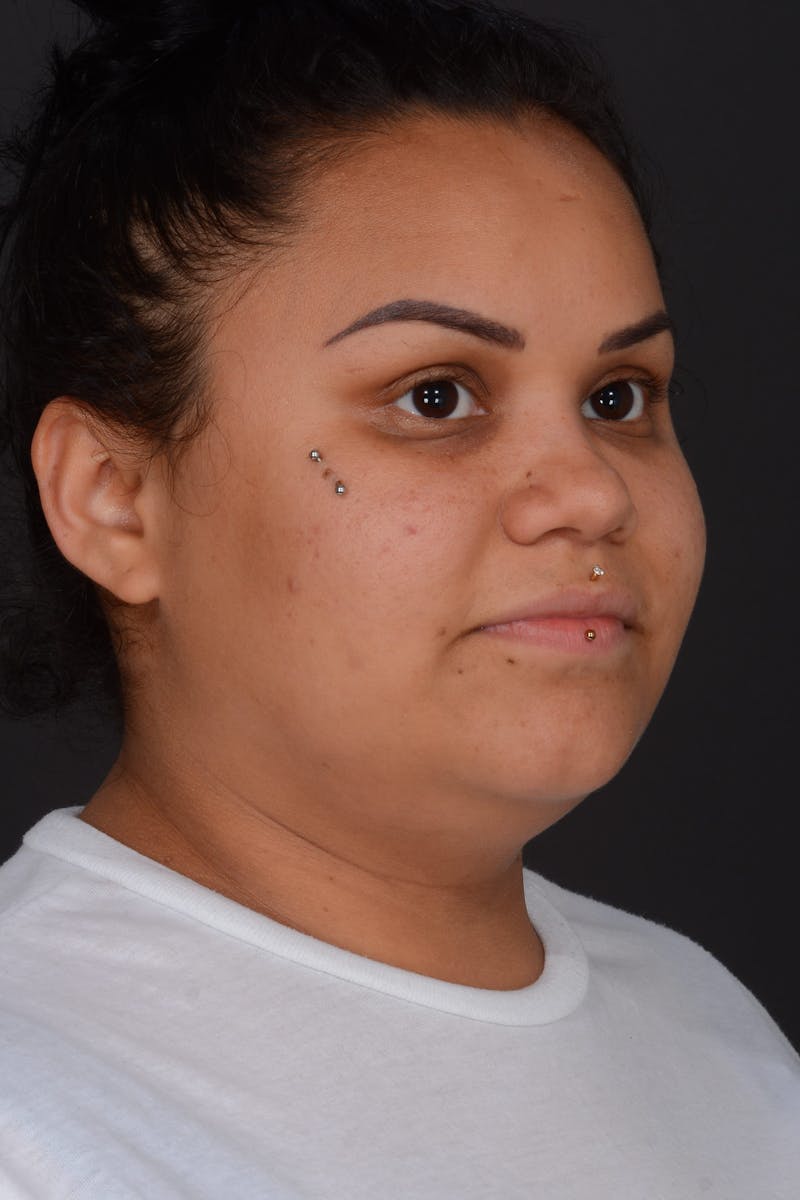 Submental Liposuction Before & After Gallery - Patient 577282 - Image 5