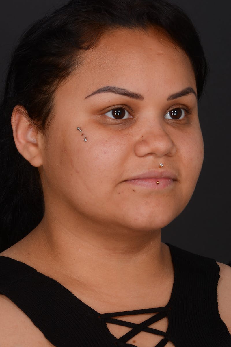 Submental Liposuction Before & After Gallery - Patient 577282 - Image 6