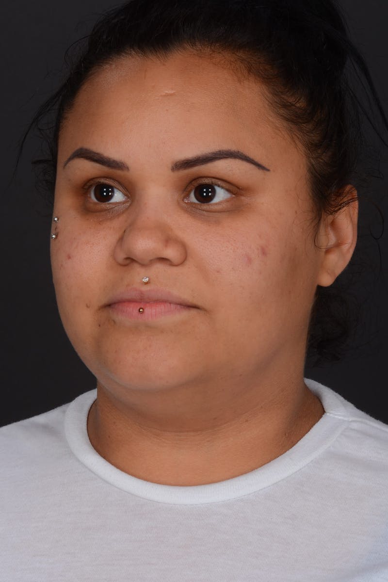 Submental Liposuction Before & After Gallery - Patient 577282 - Image 7