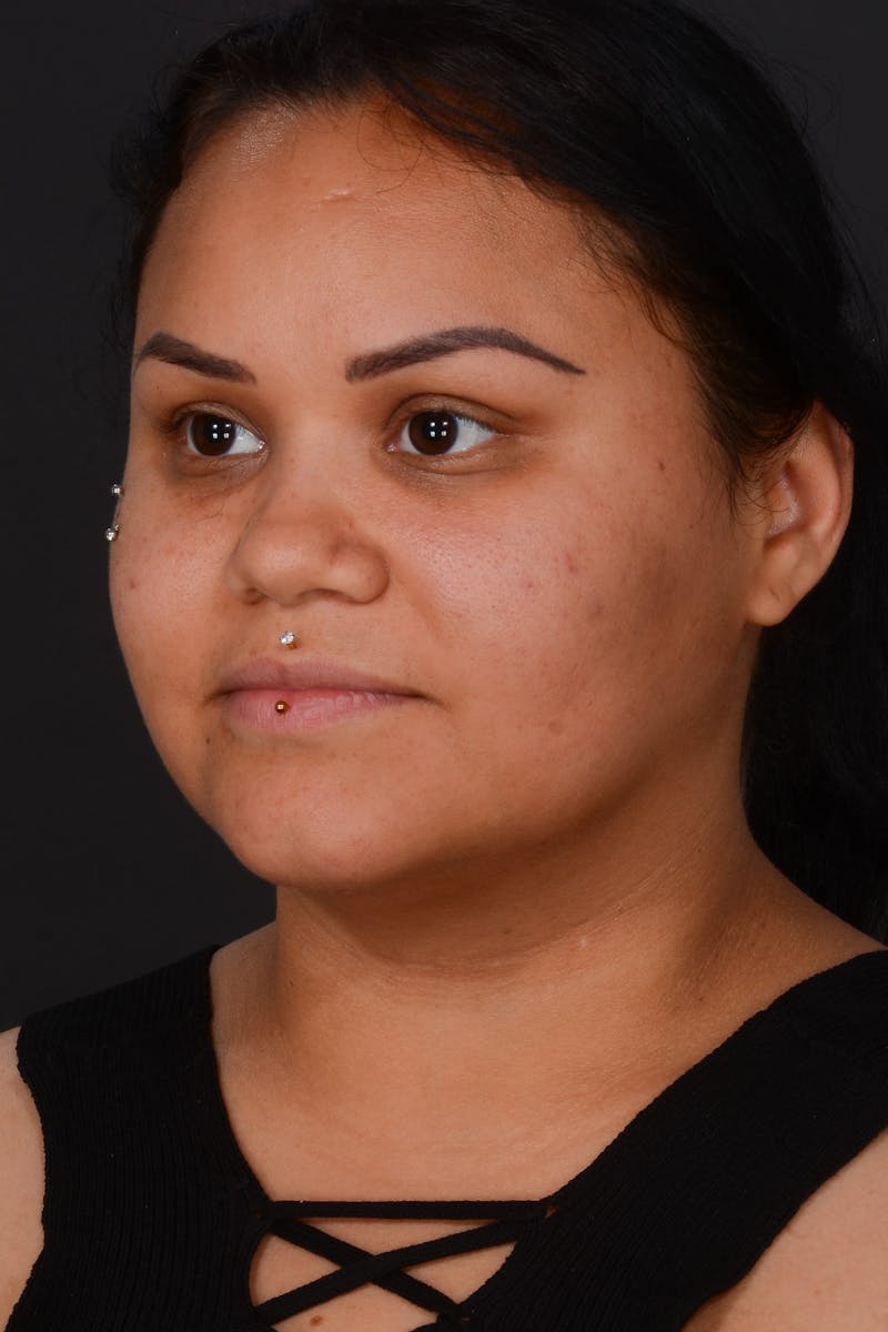 Submental Liposuction Before & After Gallery - Patient 577282 - Image 8