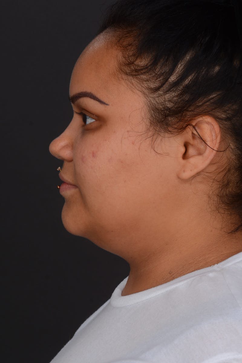 Submental Liposuction Before & After Gallery - Patient 577282 - Image 9