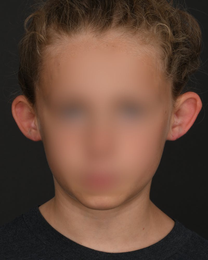 Ear Pinning Before & After Gallery - Patient 323660 - Image 1