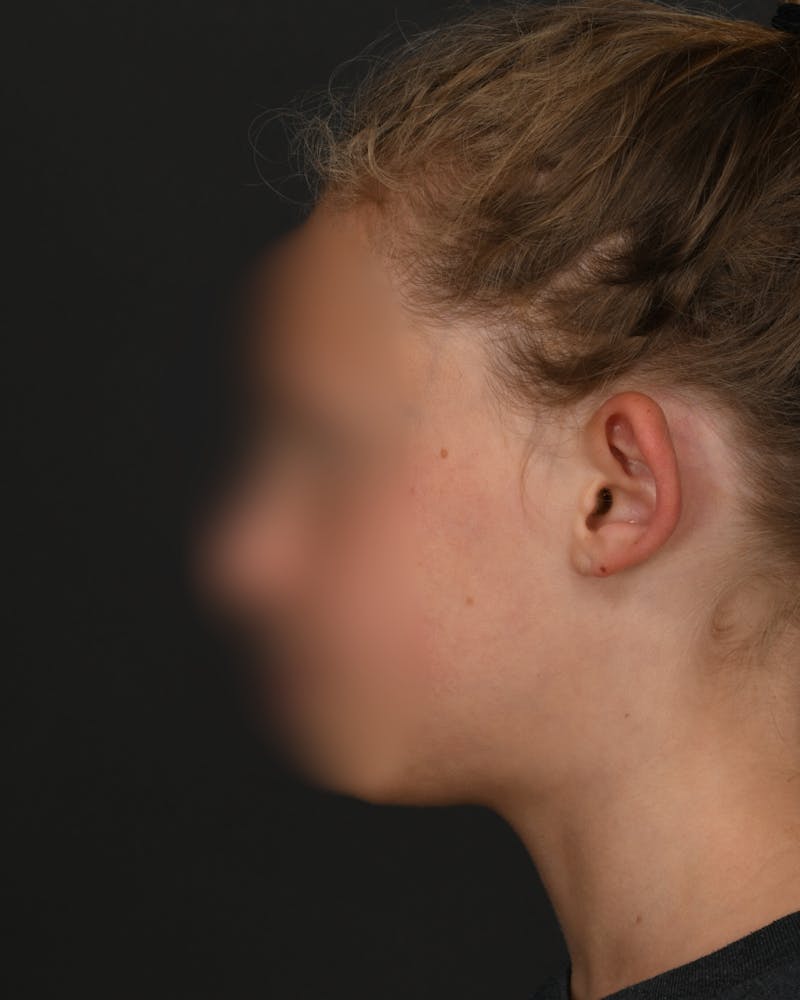 Ear Pinning Before & After Gallery - Patient 323660 - Image 3