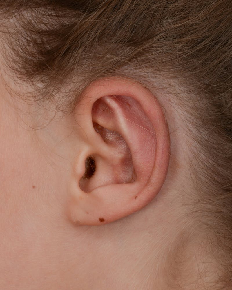 Ear Pinning Before & After Gallery - Patient 323660 - Image 6