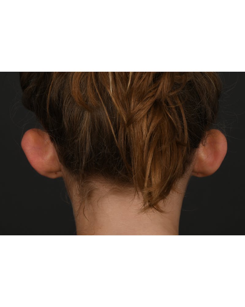 Ear Pinning Before & After Gallery - Patient 323660 - Image 7