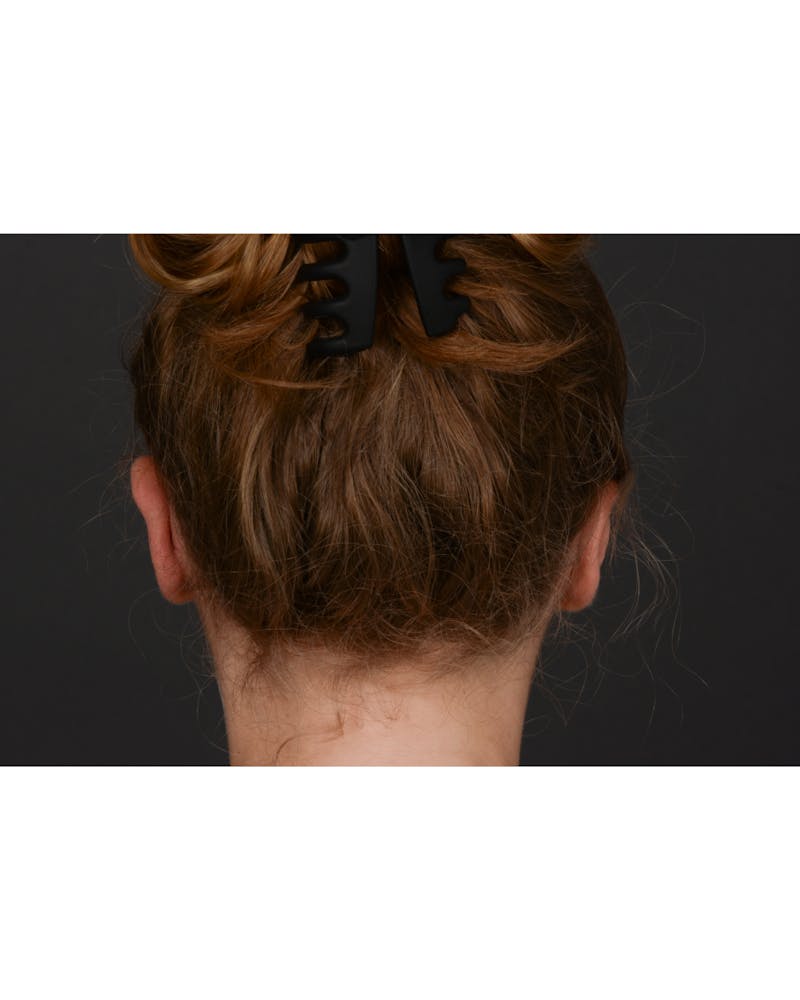 Ear Pinning Before & After Gallery - Patient 323660 - Image 8