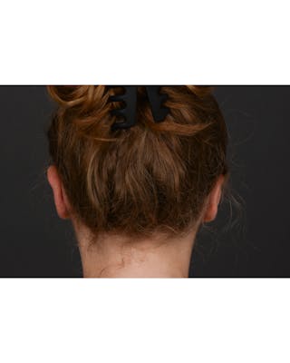 Ear Pinning Before & After Gallery - Patient 323660 - Image 8