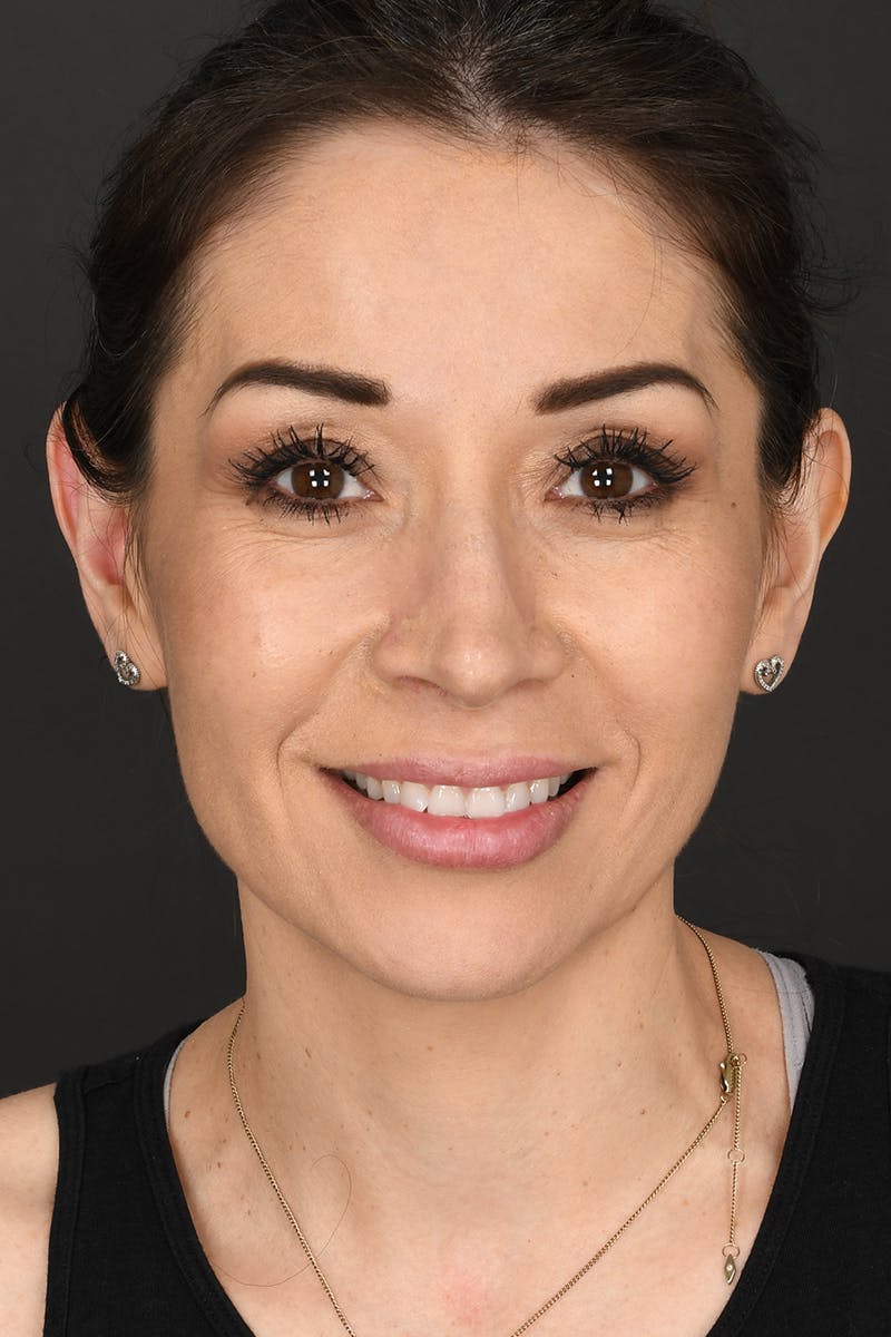 Ear Pinning Before & After Gallery - Patient 197659 - Image 1