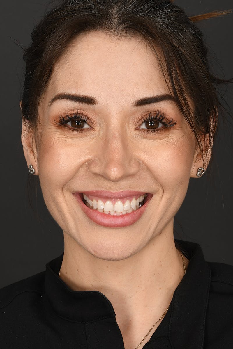 Ear Pinning Before & After Gallery - Patient 197659 - Image 2