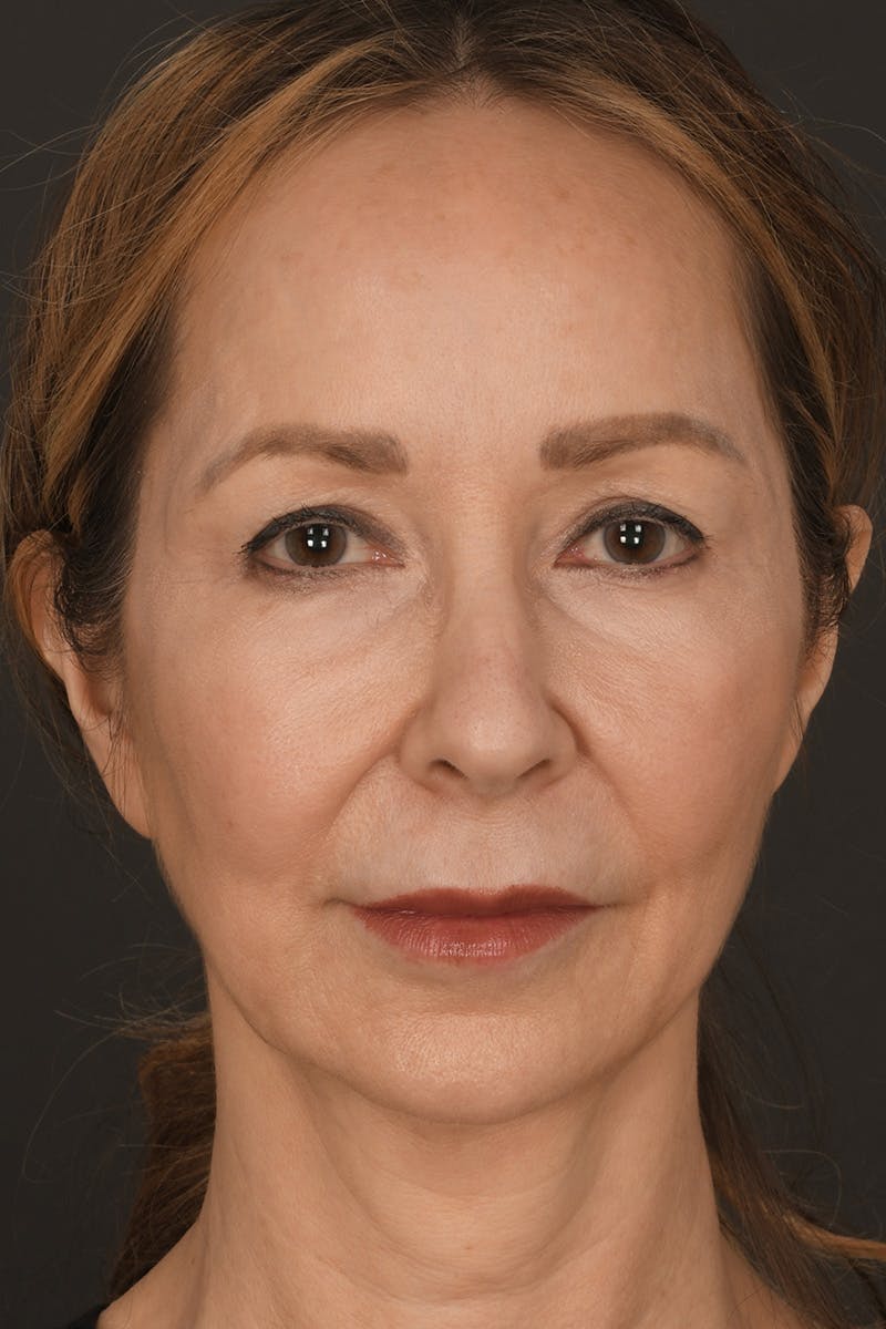 Brow Lift Before & After Gallery - Patient 360453 - Image 1