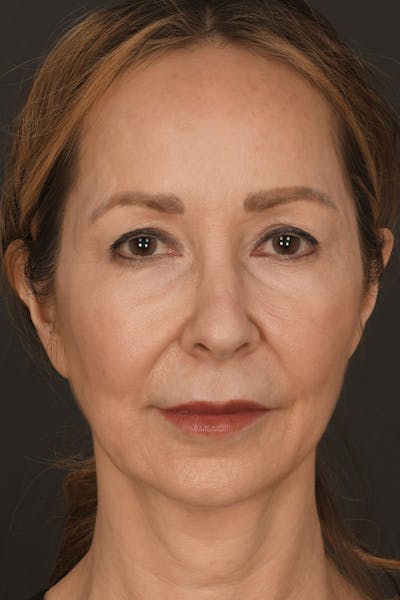 Brow Lift Before & After Gallery - Patient 360453 - Image 1