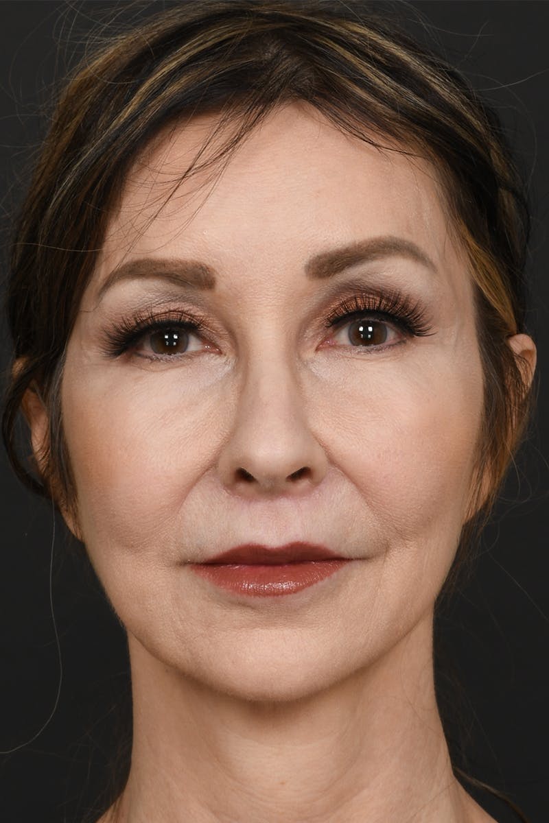 Brow Lift Before & After Gallery - Patient 360453 - Image 2