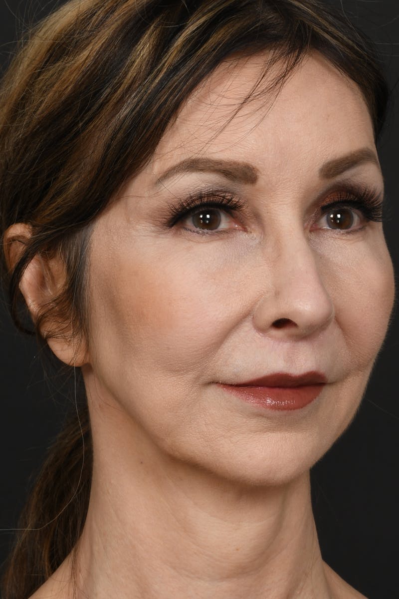 Brow Lift Before & After Gallery - Patient 360453 - Image 4