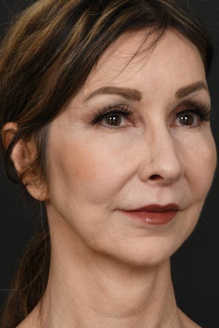 Brow Lift Before & After Gallery - Patient 360453 - Image 4