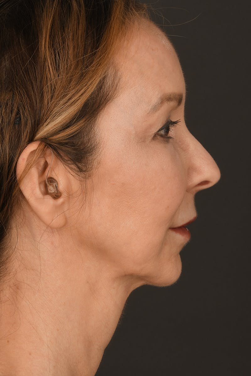 Brow Lift Before & After Gallery - Patient 360453 - Image 5