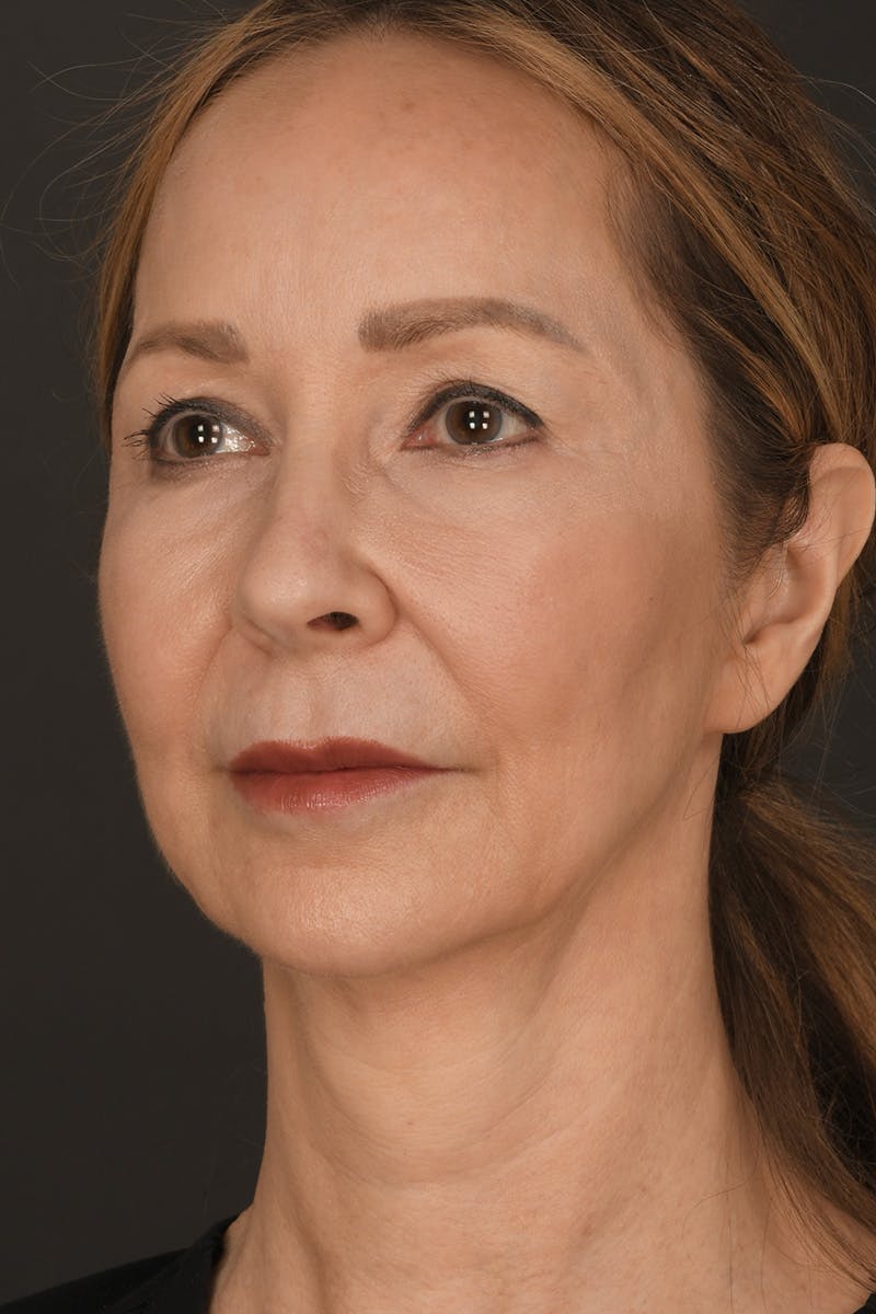 Brow Lift Before & After Gallery - Patient 360453 - Image 7