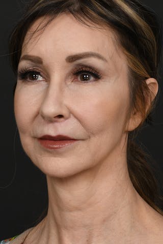 Brow Lift Before & After Gallery - Patient 360453 - Image 8