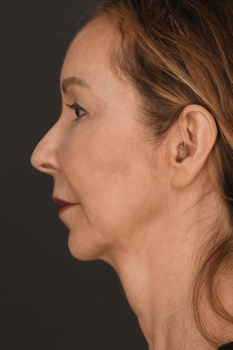 Brow Lift Before & After Gallery - Patient 360453 - Image 9