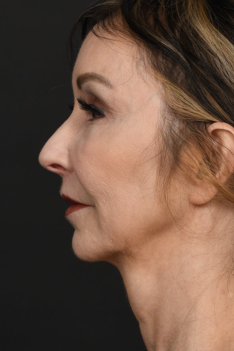 Brow Lift Before & After Gallery - Patient 360453 - Image 10