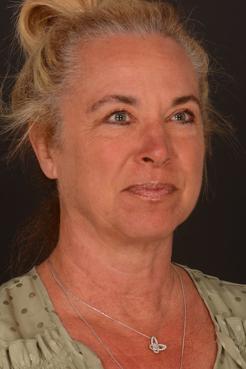 Brow Lift Before & After Gallery - Patient 157802 - Image 1