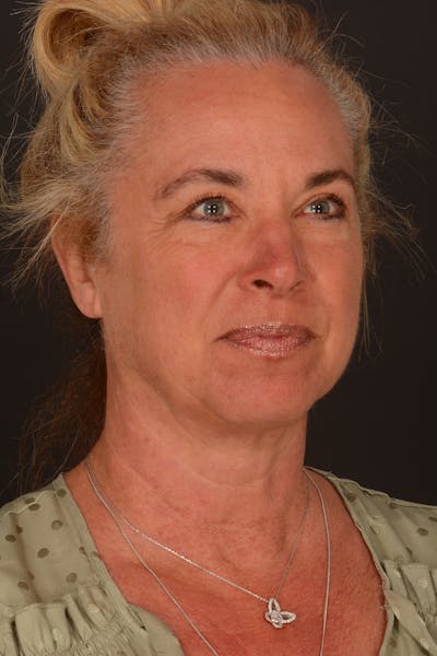 Brow Lift Before & After Gallery - Patient 157802 - Image 1