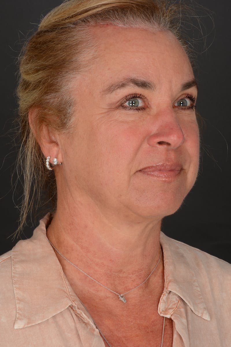 Brow Lift Before & After Gallery - Patient 157802 - Image 2