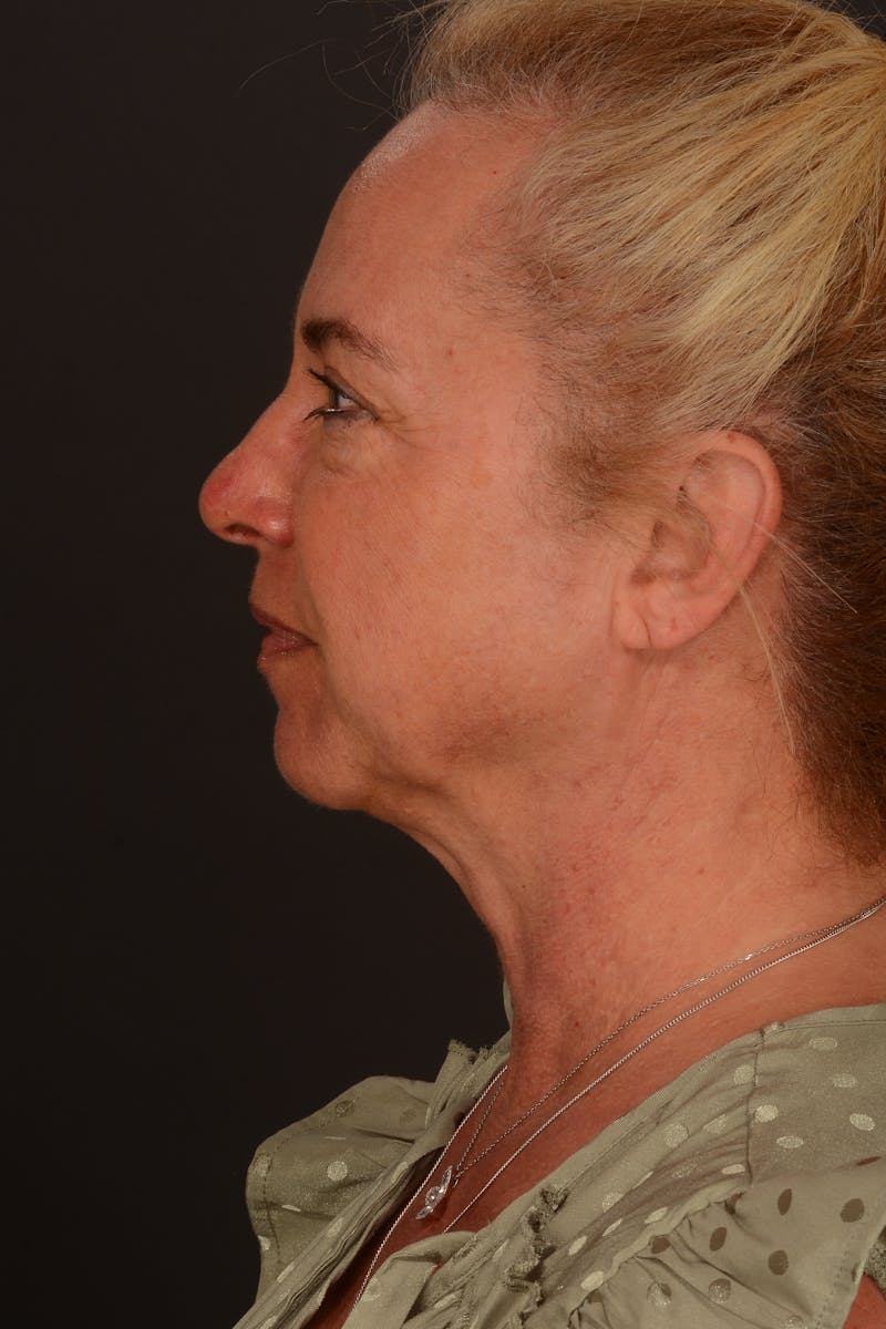 Brow Lift Before & After Gallery - Patient 157802 - Image 3