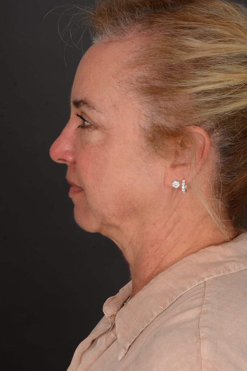 Brow Lift Before & After Gallery - Patient 157802 - Image 4