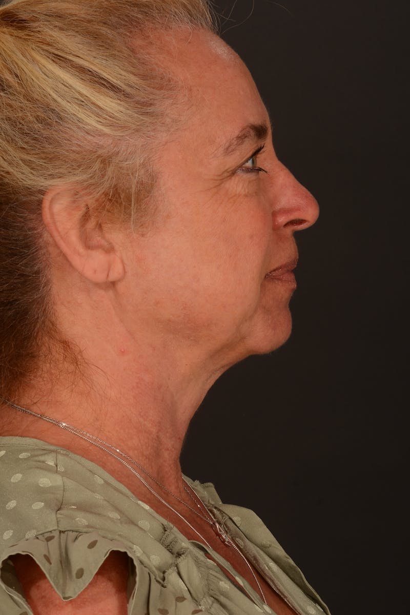 Brow Lift Before & After Gallery - Patient 157802 - Image 5